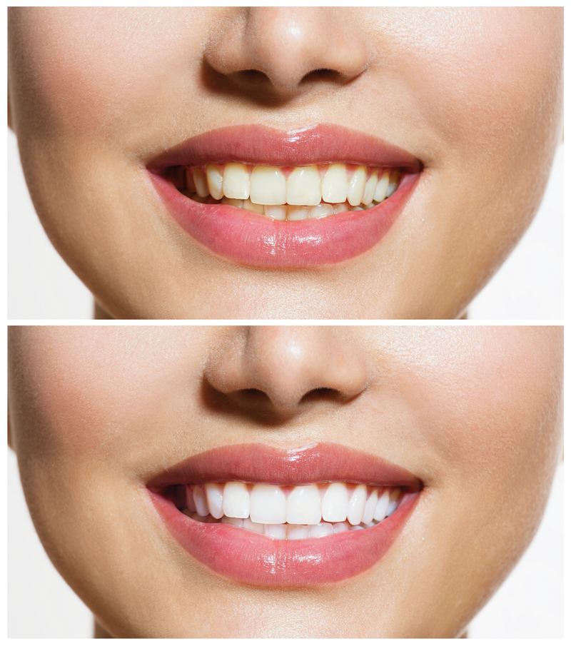Bleaching & Ästhetik